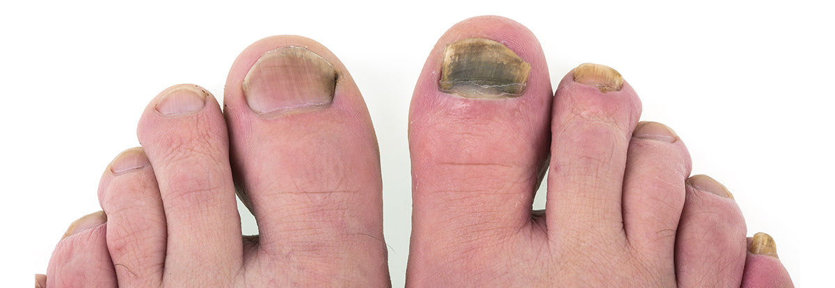 Preliminary Signs of a Foot Infection and What to Do About It – Blizzard