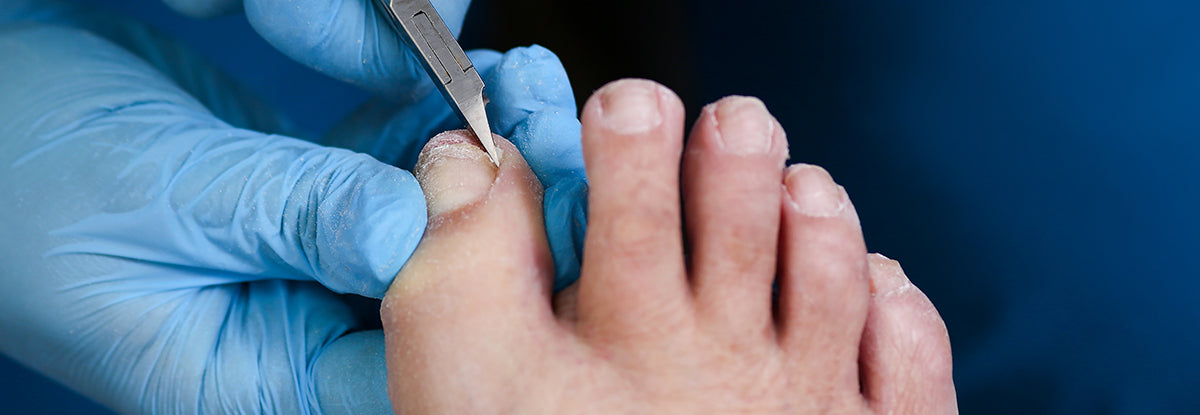 What Causes Ingrown Toenails? - Simple Common-Sense Prevention