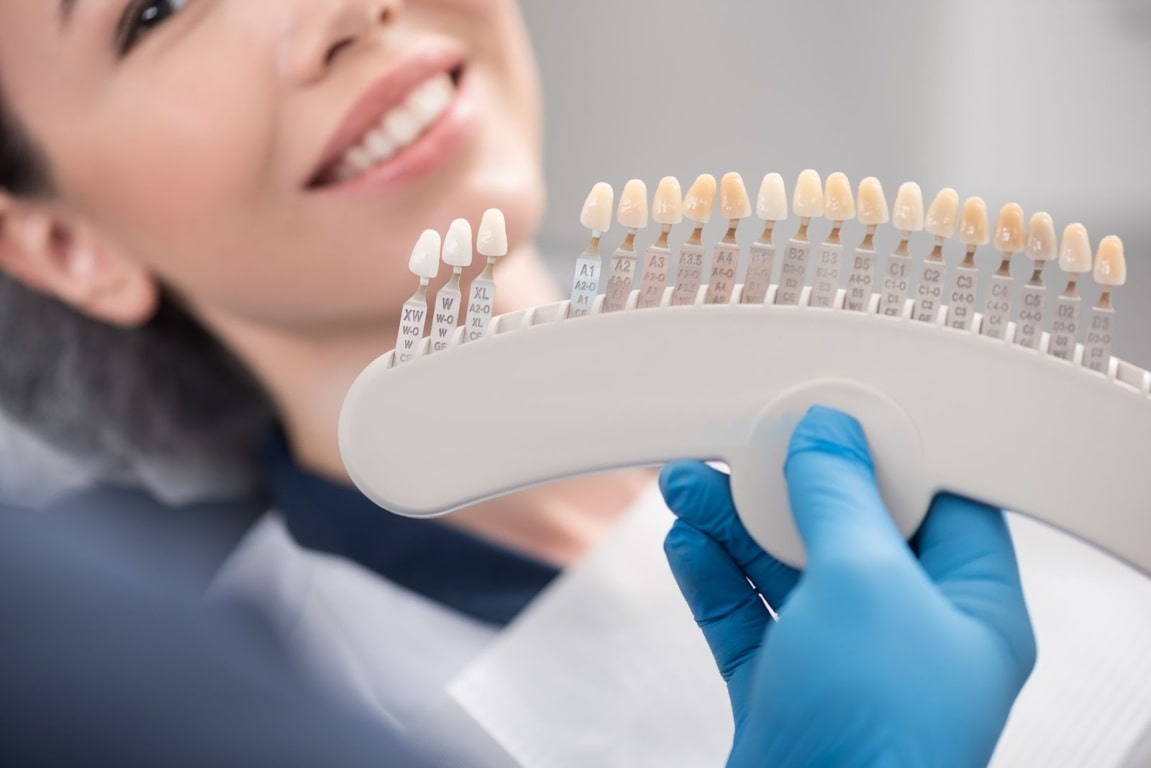 Dental Veneers in Camarillo, CA | Dental Veneers Near 93012