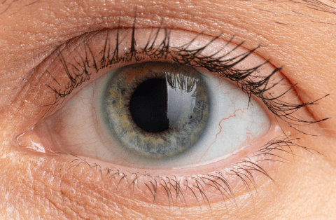 Can Cataracts Be Reversed? -Dr Sabrina™