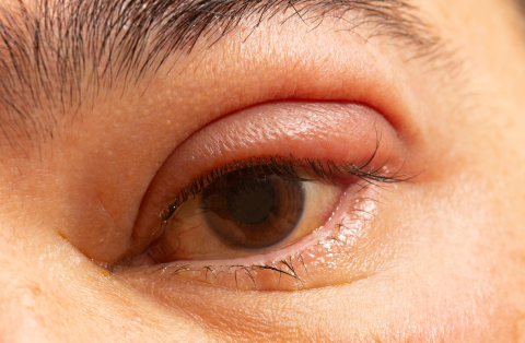 Swollen Eyelid: Causes and Treatment - Dr Sabrina™